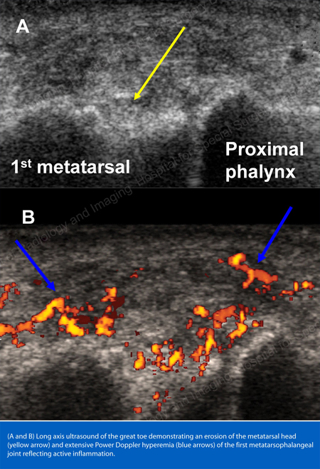 Citra ultrasonik sumbu panjang jempol kaki menunjukkan erosi kepala metatarsal (panah kuning) dan hiperemia Power Doppler ekstensif (panah biru) pada sendi metatarsophalangeal pertama yang mencerminkan peradangan aktif.