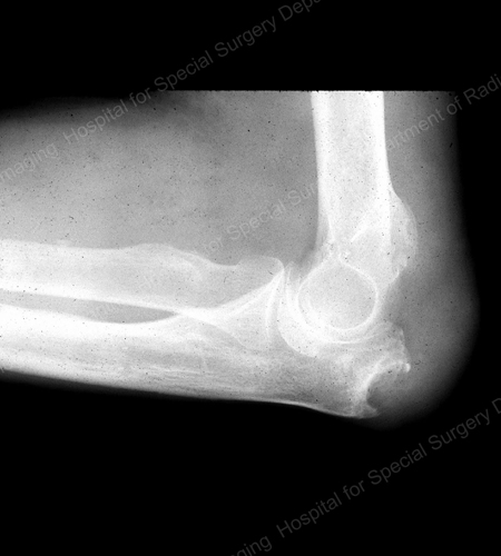 X-ray erosi gout pada ulna proksimal di siku