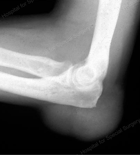 X-ray of a large tophus seen as soft tissue mass at the elbow