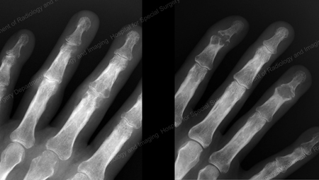 X-ray of gout of the distal finger joints