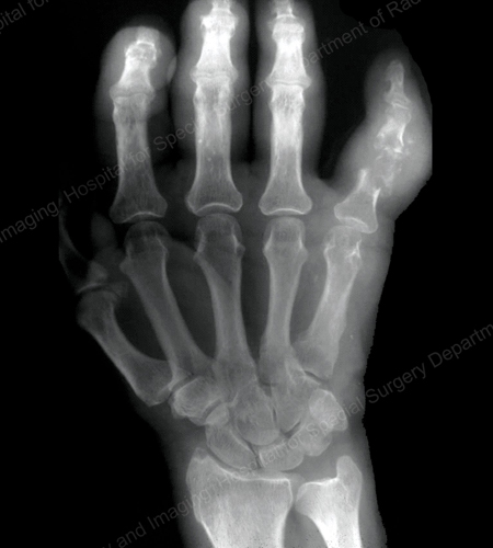 X-ray of gouty destruction at multiple finger joints