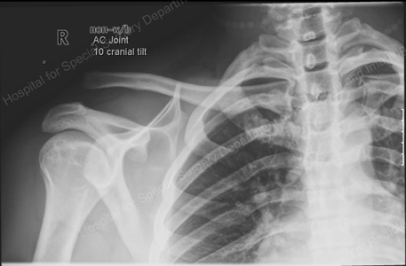 X-ray image of a shoulder separation