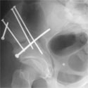 X-ray image of a hip