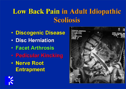 low back pain in adult idiopathic scoliosis image