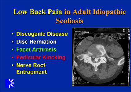low back pain in adult idiopathic scoliosis-mri image