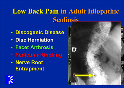 low back pain in adult idiopathic scoliosis-xray image