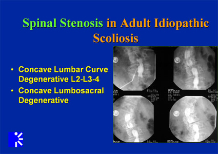 spinal stenosis- mri images
