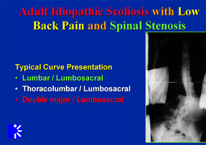 idiopathic scoliosis and spinal stenosis