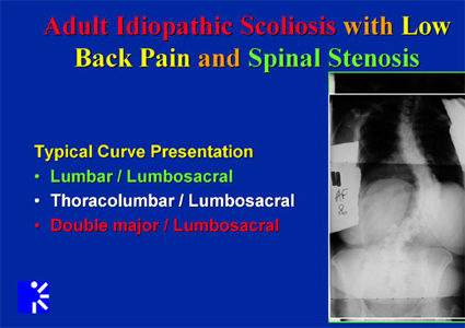 adult idiopathic scoliosis - pain - spinal stenosis xray