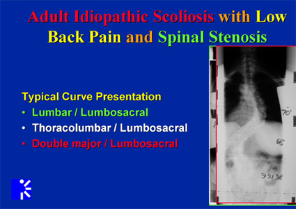 adult idiopathic scoliosis - pain - spinal stenosis xray