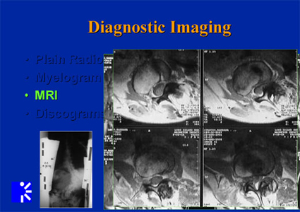 adult idiopathic scoliosis - MRI of diagnositic images