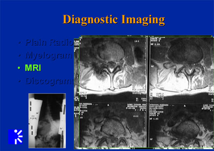 adult idiopathic scoliosis - MRI of diagnositic images