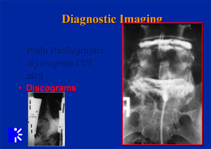 adult idiopathic scoliosis - diagnostic images - discogram