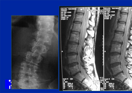 What are some symptoms of degenerative disc disease in the thoracic spine?