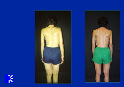 Before and after photo of a scoliosis patient.