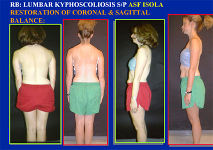 Before and after photos of a scoliosis patient.