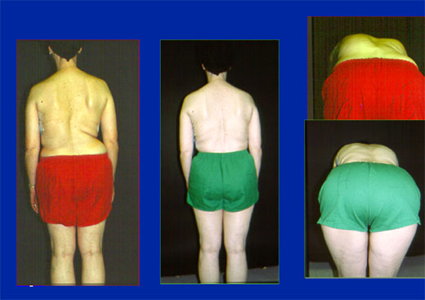 Before and after photos of adult scoliosis patient.