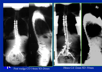 adult idiopathic scoliosis - diagnositic images