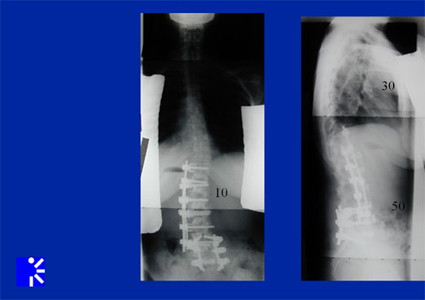 adult idiopathic scoliosis - diagnositic images