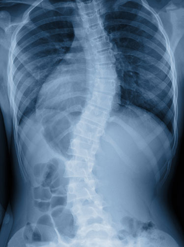 X-ray image of a patient with scoliosis