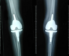 X-ray image of both knees with implants after surgery