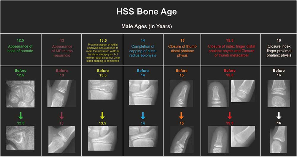 Bone Age Estimation Chart