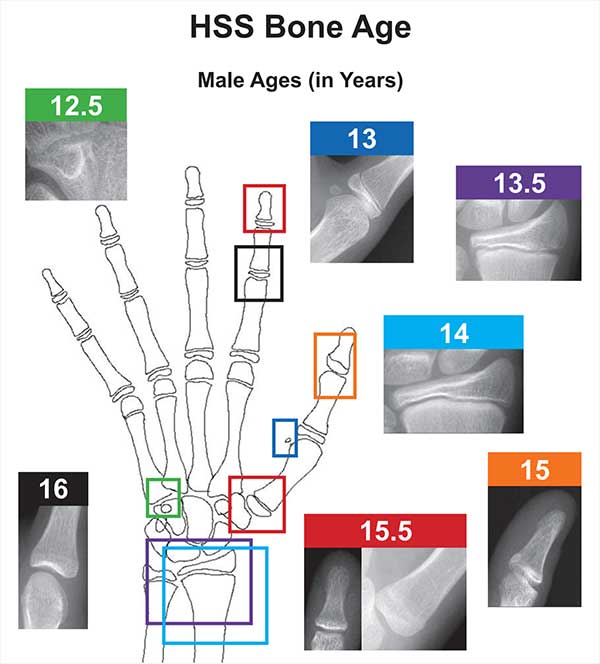 Bone Age Estimation Chart