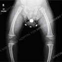 X-ray of bow leg deformity