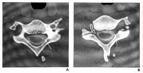 CT Myelogram Showing a Normal Brachial Plexus (left) CT Myelogram Showing an Injured Brachial Plexus (right)