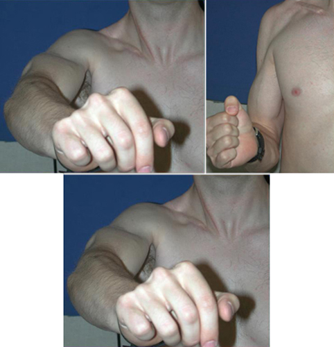 The Patient After Brachial Plexus Surgical Repair, exhibiting his recovery of function.