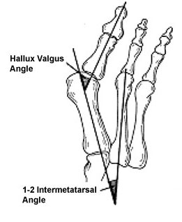 Illustration of foot showing bunion with metatarsus primus varus and normal valgus