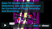 Image - thumbnail of Case 13: Double Level Tibial Osteotomy and Joint Replacement for Correction of Valgus Deformity and Shortening video.