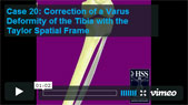 Image - thumbnail of Case 20: Correction of a Varus Deformity of the Tibia with the Taylor Spatial Frame video.