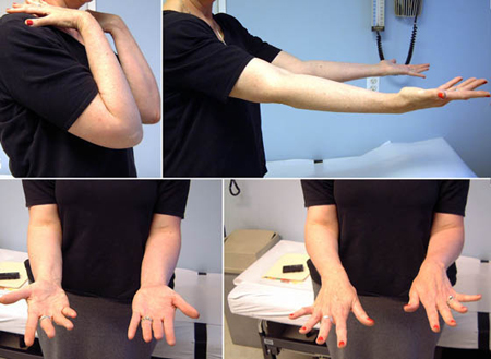 clinical photos at 12 months healed monteggia fracture-dislocations from a case example presented by the orthopedic trauma service at Hospital for Special Surgery.