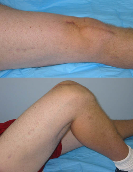 clinical photos at 1 year illustrating functional range of motion from a case example of open fractures from the orthopedic trauma service at Hospital for Special Surgery.
