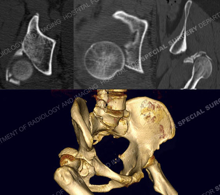 CT scan images and 3D CT reconstruction revealing acetabular fracture from a case example presented by the orthopedic trauma service at Hospital for Special Surgery.