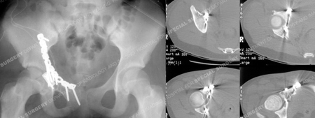 post-operative CT scans show placement of screws and spring plate from case example presented by the orthopedic trauma service at Hospital for Special Surgery.