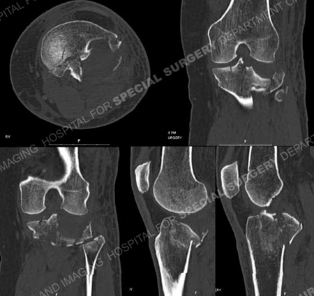 CT Scan images further delineating fracture pattern from a case example of schatzker II tibial plateau fracture from the orthopedic trauma service at Hospital for Special Surgery.