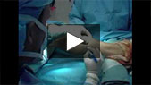 Image - Thumbnail of Live Surgery Demonstration of Proximal Tibial Ostectomy for Bilateral genu varum, using the Ilizarov/Taylor Spatial Frame video.