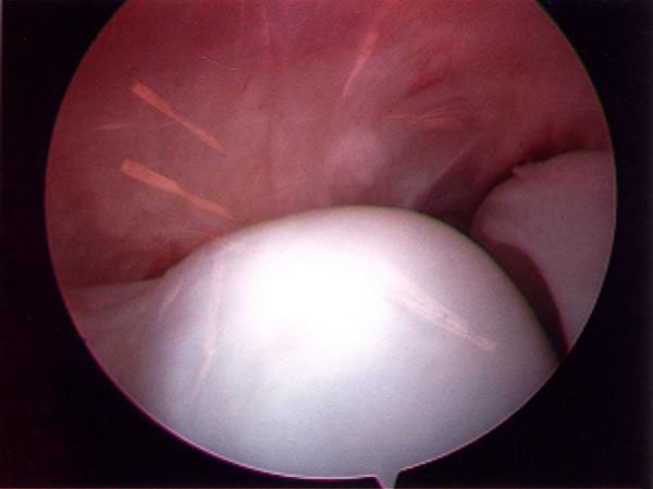 Image of the elbow joint obtained through arthroscopy
