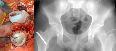 Intra-operative photos of femoral head and x-ray post-operative of pelvis from a case example presented by the orthopedic trauma service at Hospital for Special Surgery.