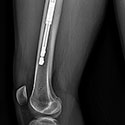 X-ray image of femur