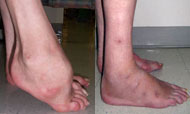 Before and After Foot Deformity Corrections from Hospital for Special Surgery