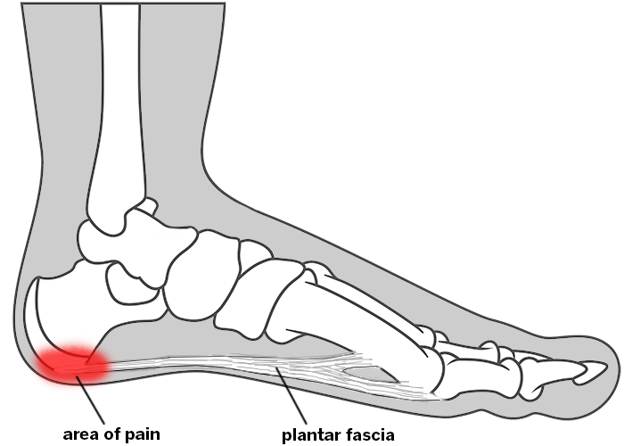 diagram of foot and plantar fasciitis heel pain