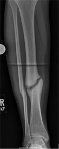 X-ray before image