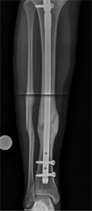 X-ray after image