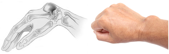 Ganglion cyst of the wrist