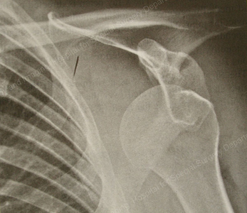 X-ray image of glenohumeral (GH) dislocation