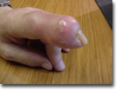 Photo of gout tophi draining to the surface of the skin