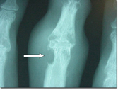 X-ray changes in chronic tophaceous gout
